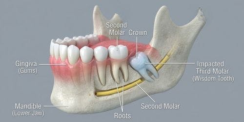Wisdom teeth extraction consultation and treatment